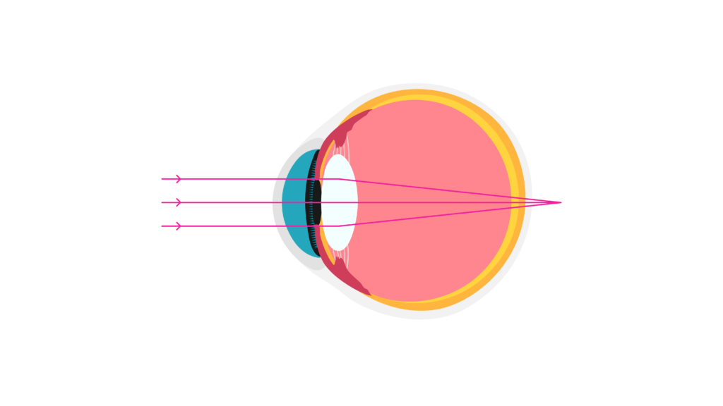 cirurgia refrativa