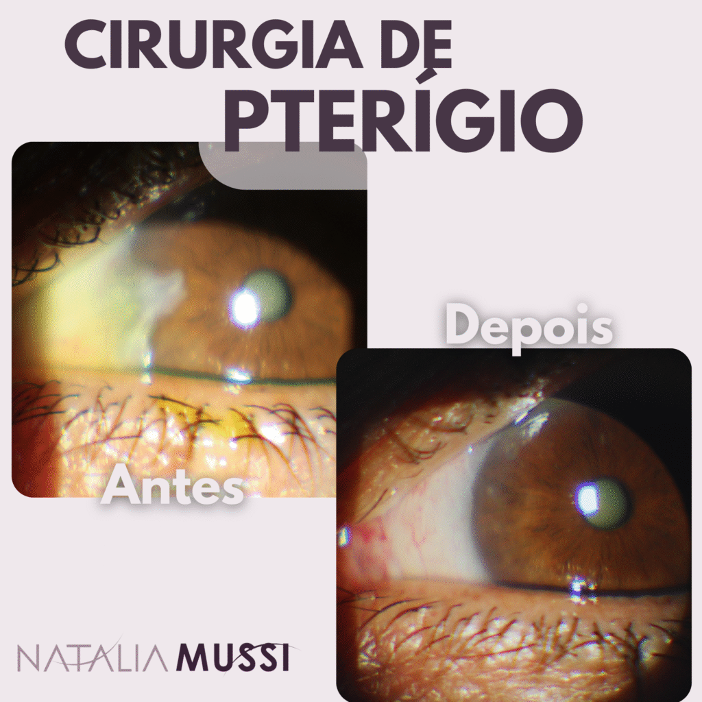 cirurgia de ptg